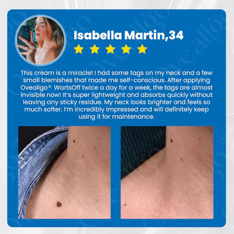 ✅ Official Store: Oveallgo® WartsOff Pro Instant Blemish Removal Cream👩⚕️USA Dermatology Association (AADA)Approved (Skin Tags, Warts, Dark Spots Removal)